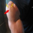 impingement impingement